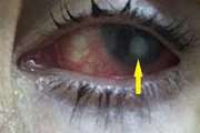 From the diagnosis of infectious keratitis to discriminating fungal subtypes a deep learningm based study